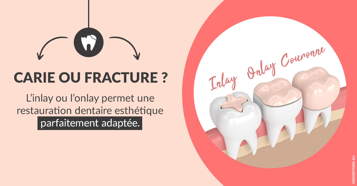 https://www.centredentairetoulon.fr/T2 2023 - Carie ou fracture 2