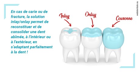 https://www.centredentairetoulon.fr/L'INLAY ou l'ONLAY