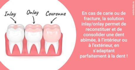 https://www.centredentairetoulon.fr/L'INLAY ou l'ONLAY 2